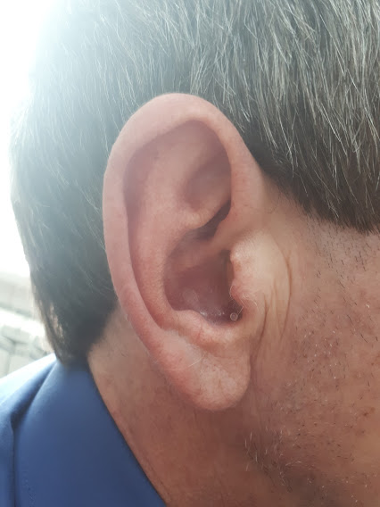 Внутриканальный слуховой аппарат фирмы Widex модели Dream 220 m, изготовленный по индивидуальному слепку уха